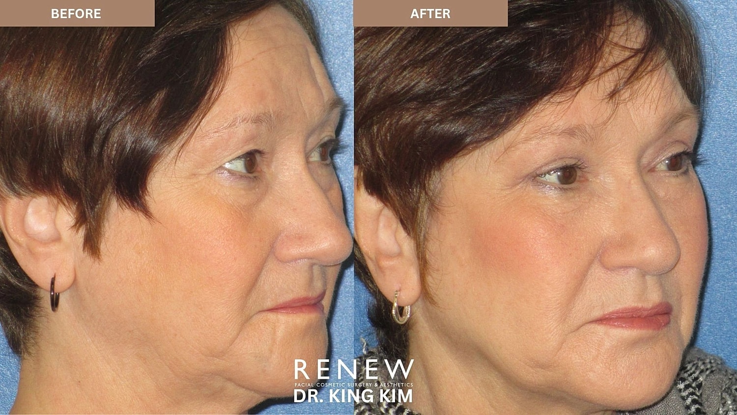 Blepharoplasty Before & After