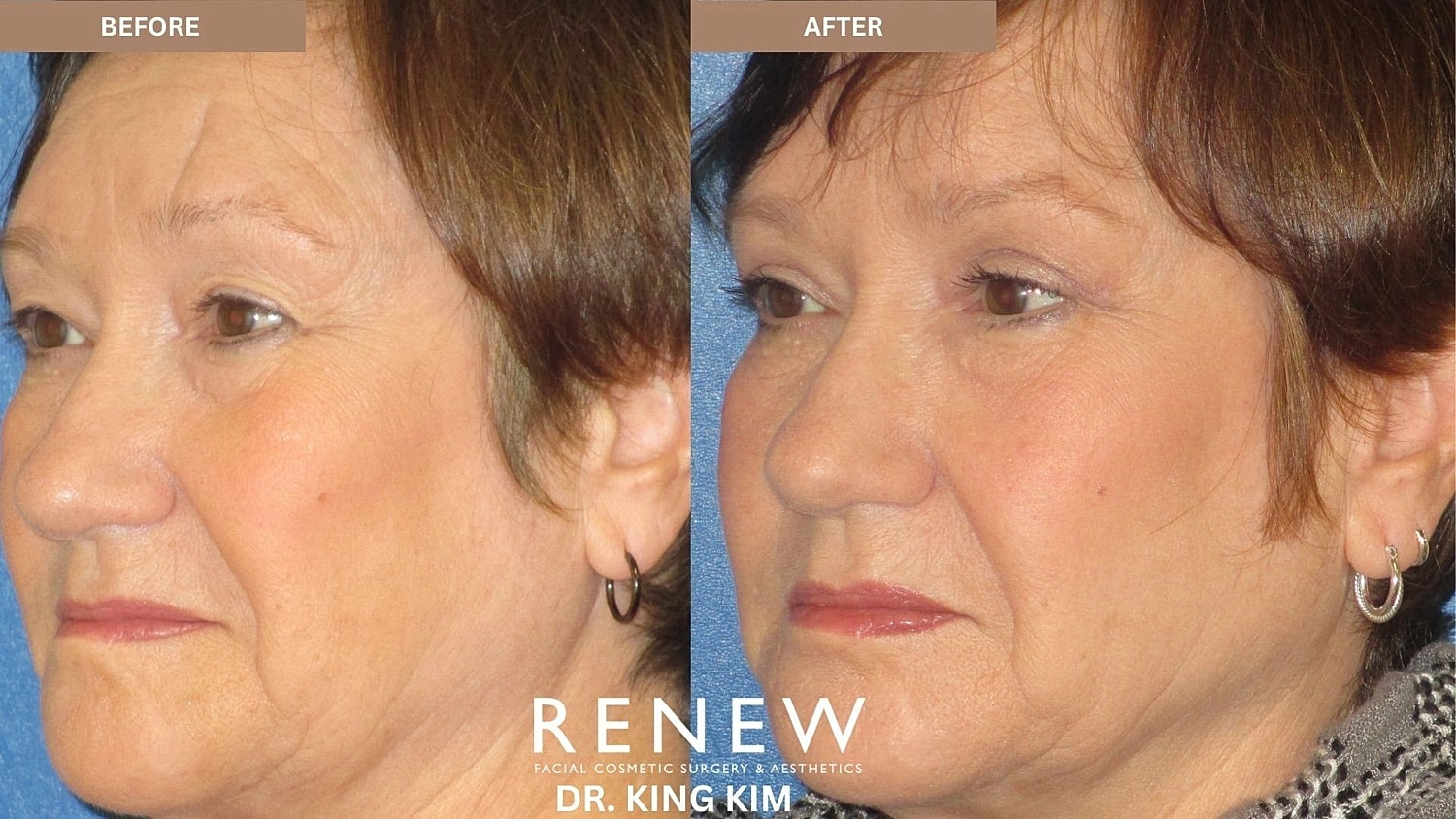 Blepharoplasty Before & After