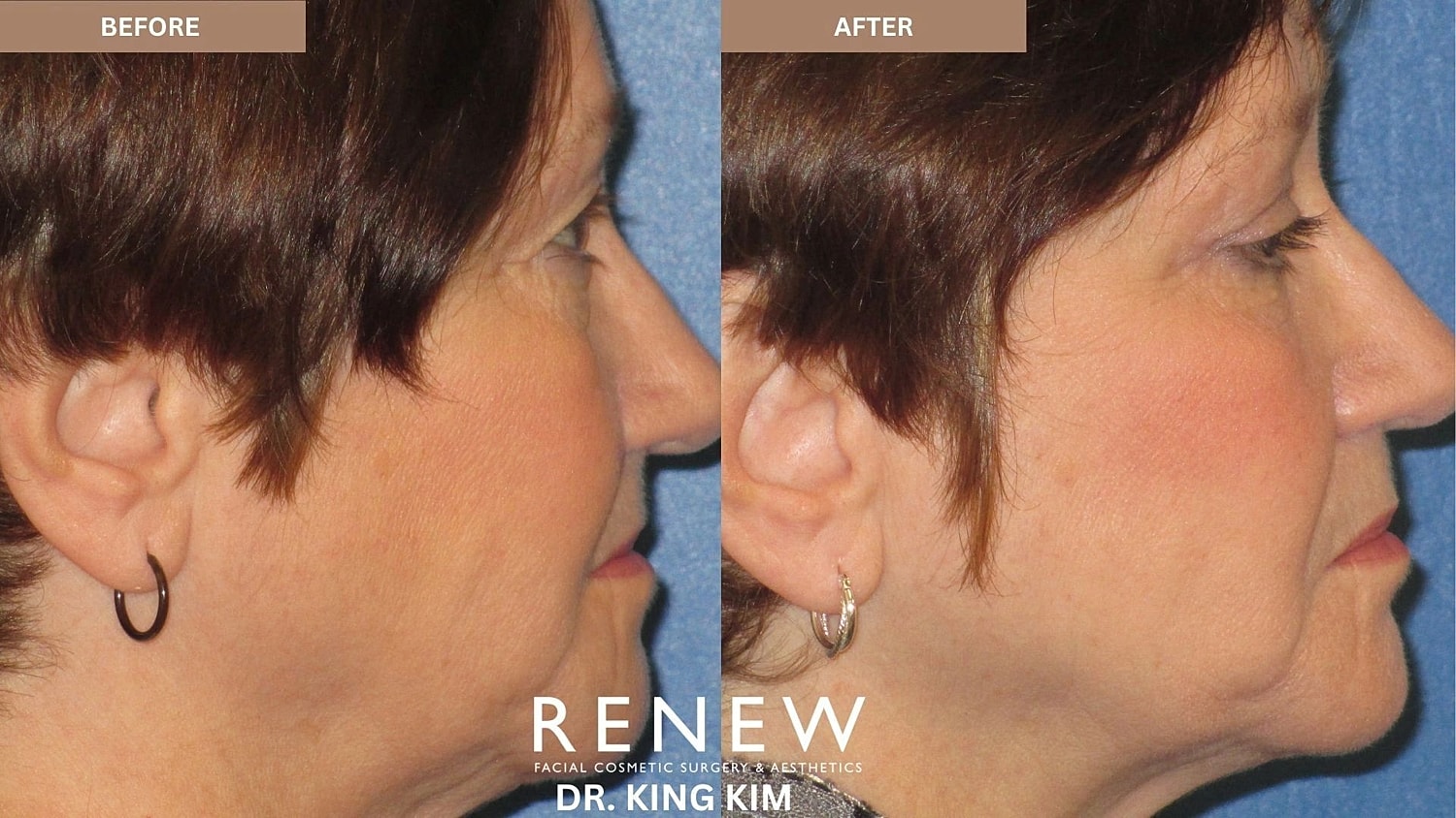Blepharoplasty Before & After