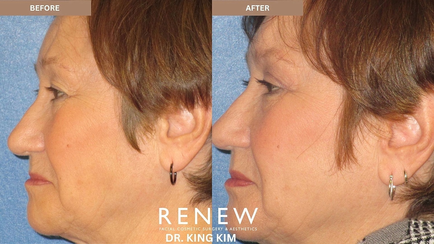 Blepharoplasty Before & After