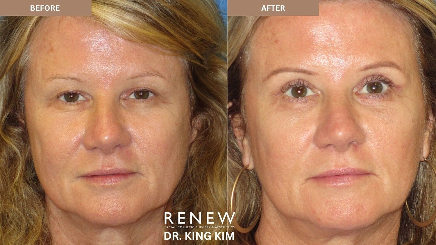 Blepharoplasty Before & After