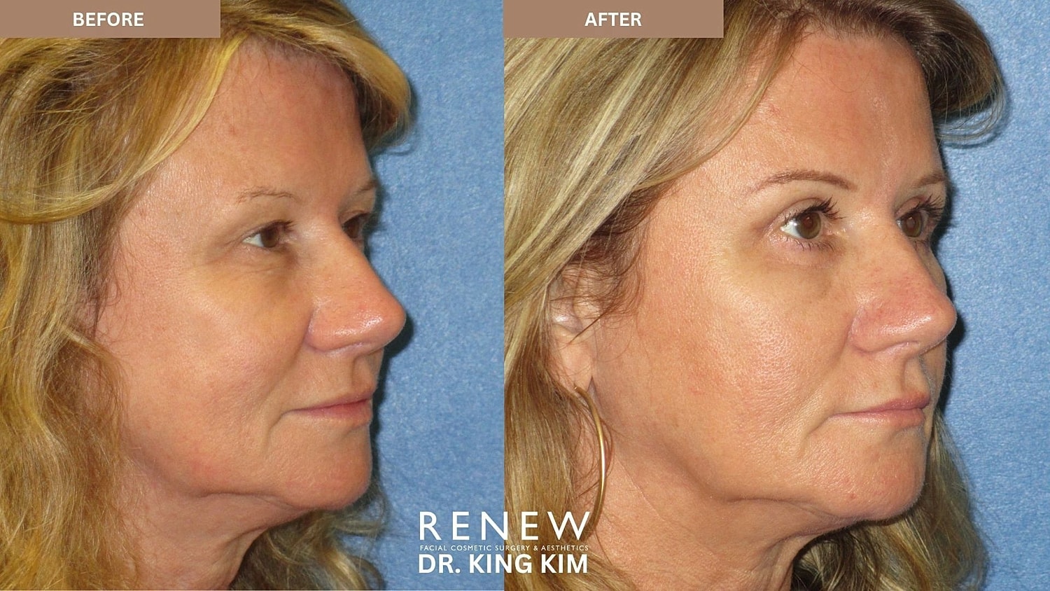 Blepharoplasty Before & After