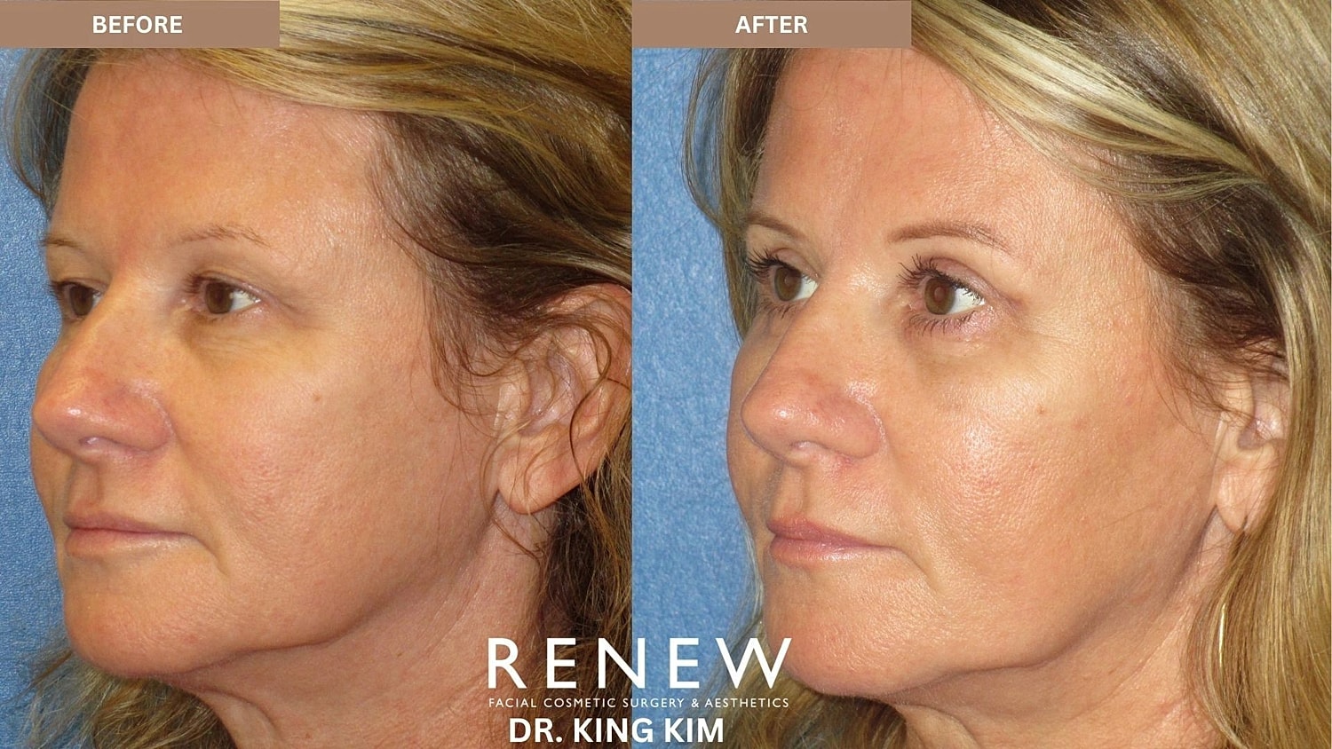 Blepharoplasty Before & After