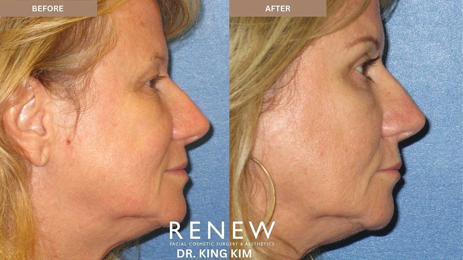 Blepharoplasty Before & After