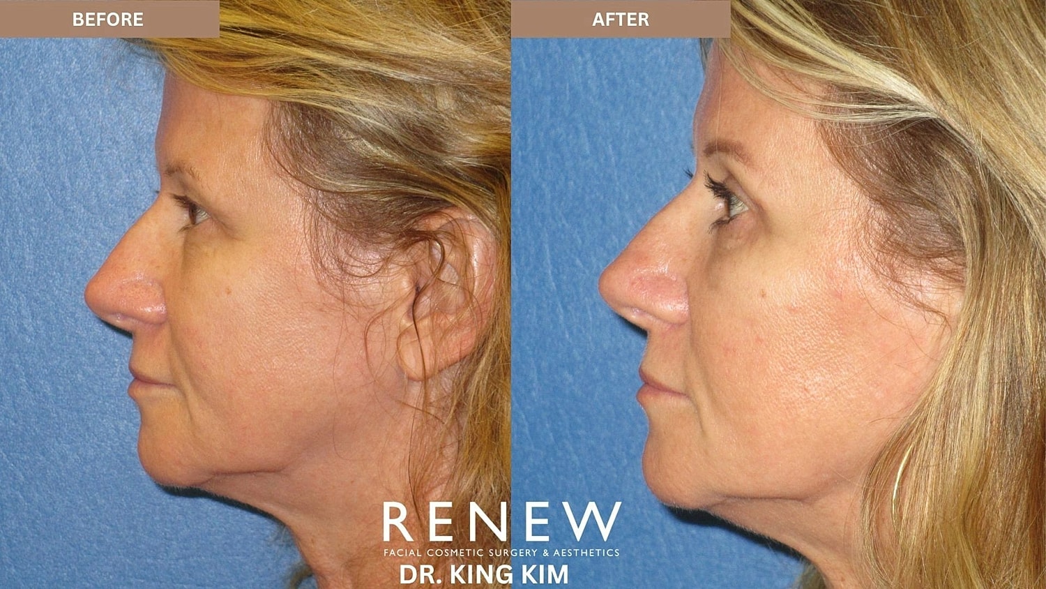 Blepharoplasty Before & After