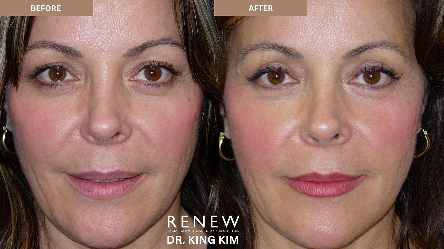Blepharoplasty Before & After