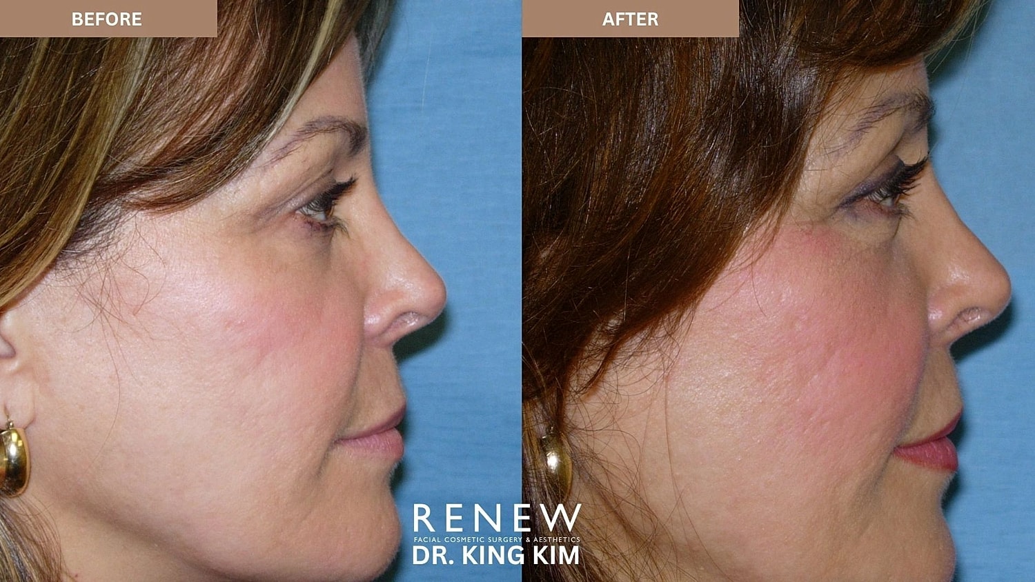 Blepharoplasty Before & After