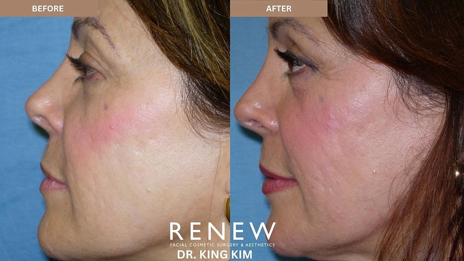 Blepharoplasty Before & After