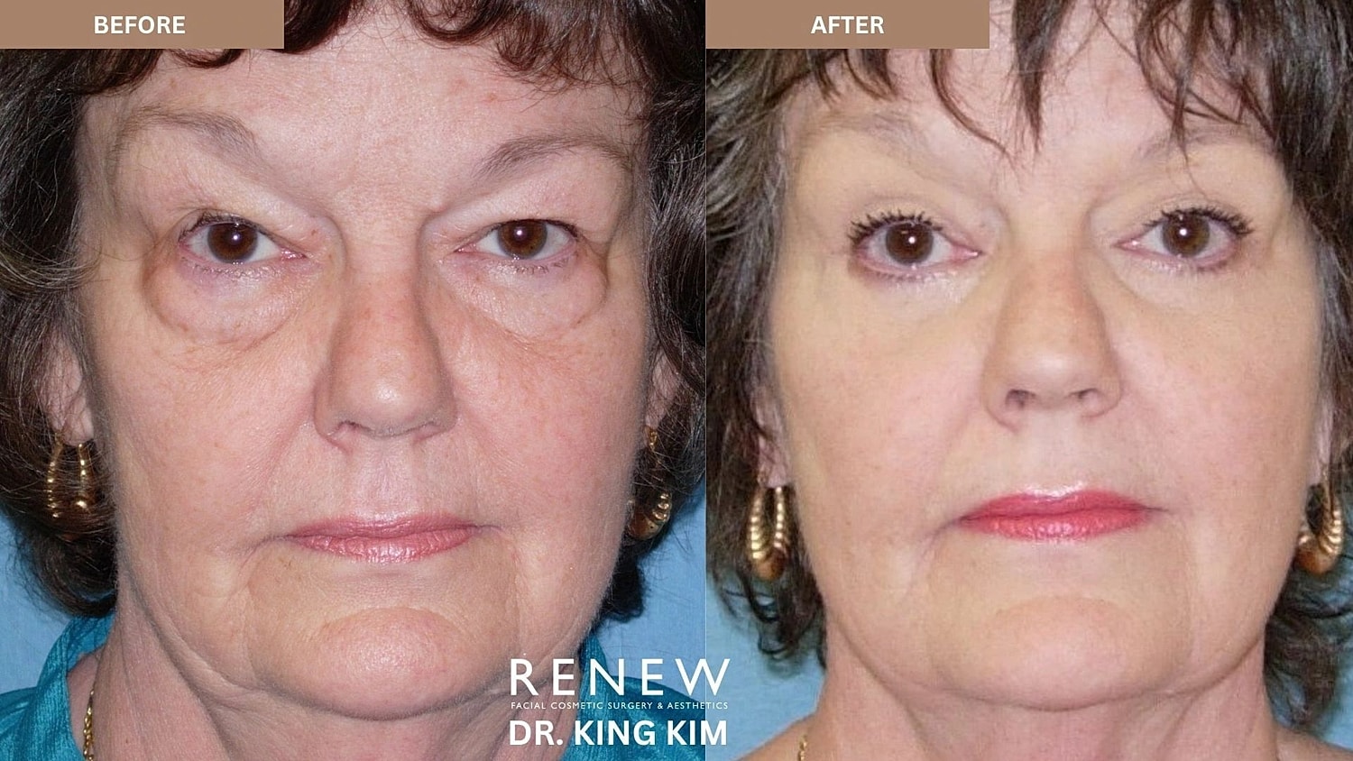 Blepharoplasty Before & After