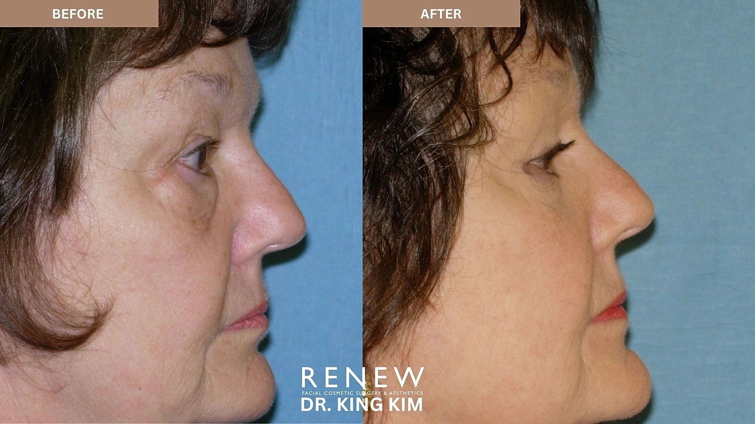 Blepharoplasty Before & After