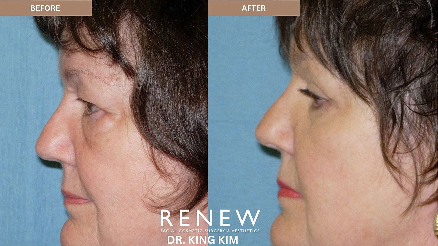 Blepharoplasty Before & After