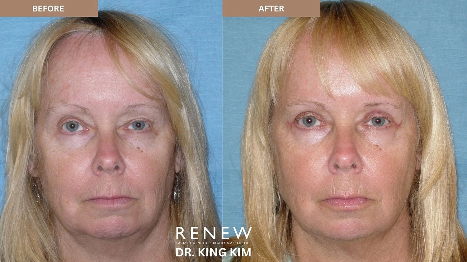Blepharoplasty Before & After