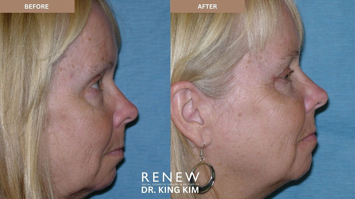 Blepharoplasty Before & After