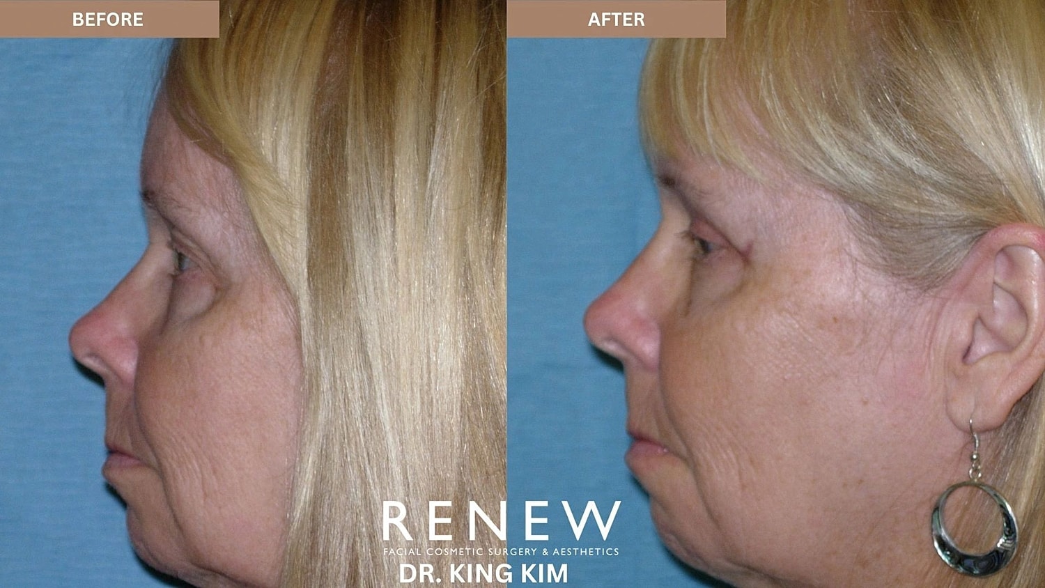 Blepharoplasty Before & After