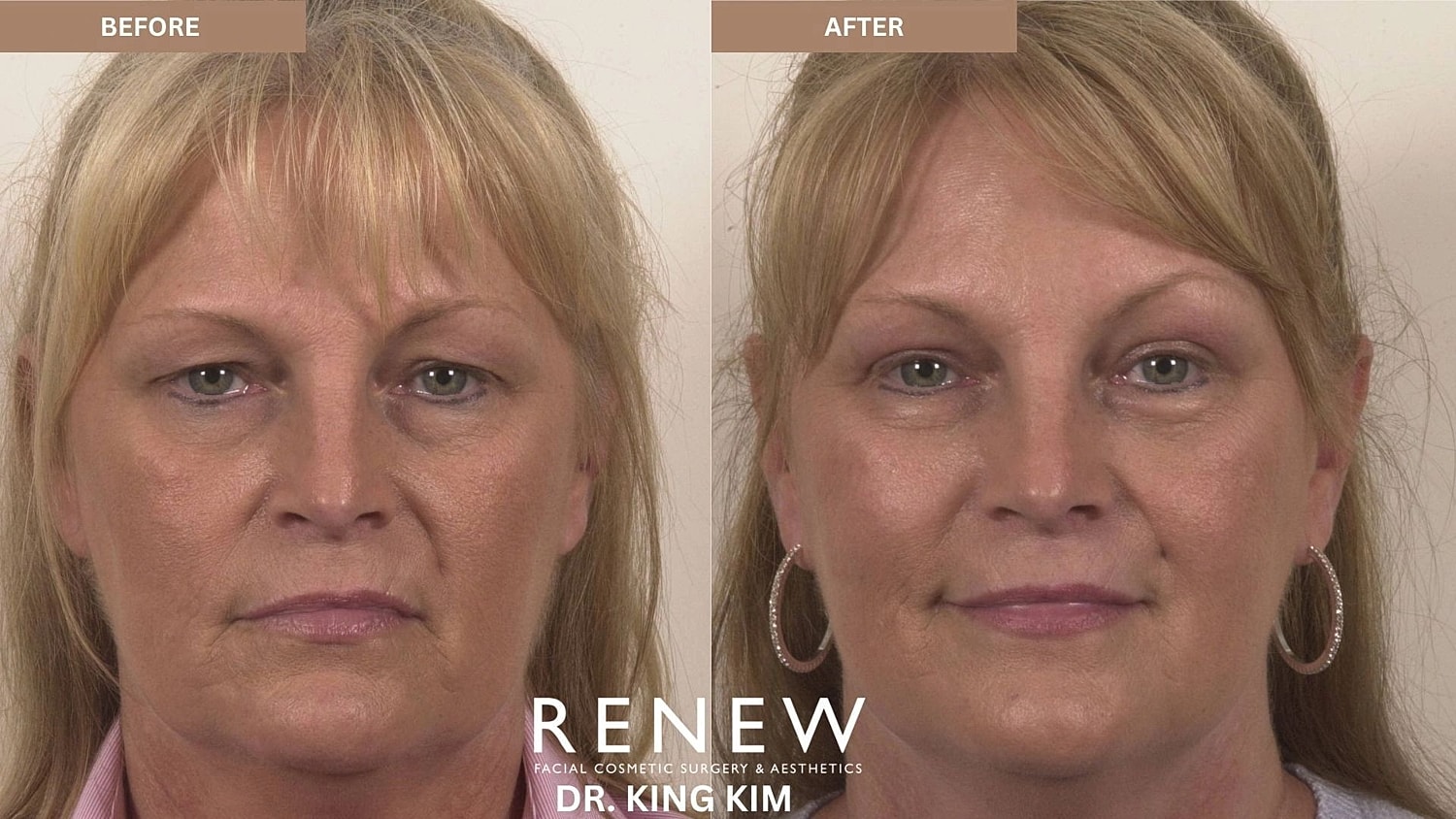 Blepharoplasty Before & After