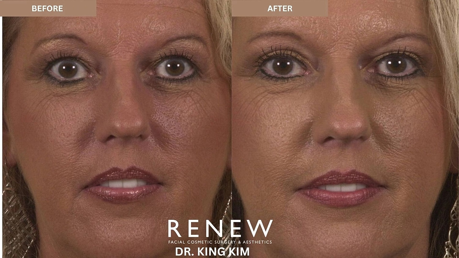 Blepharoplasty Before & After