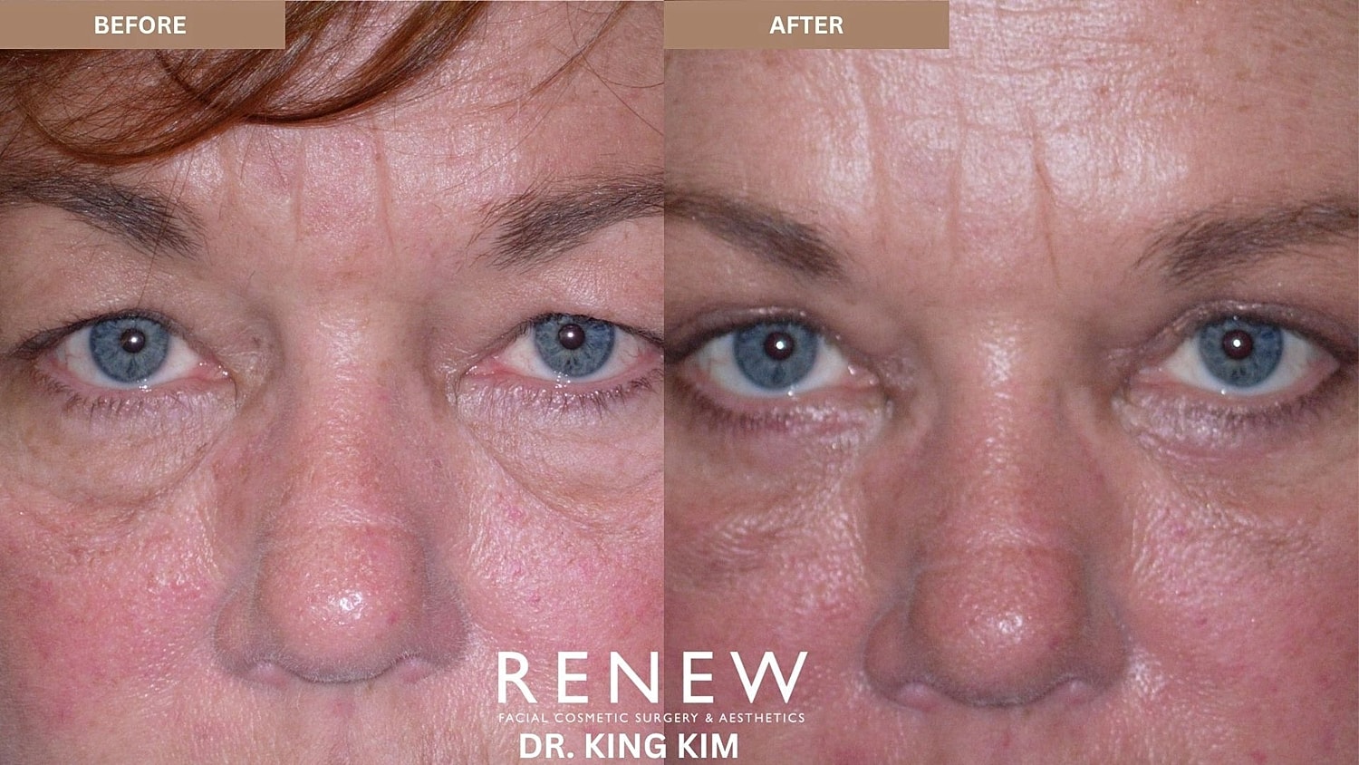 Blepharoplasty Before & After