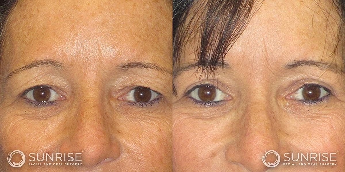 Blepharoplasty Before & After