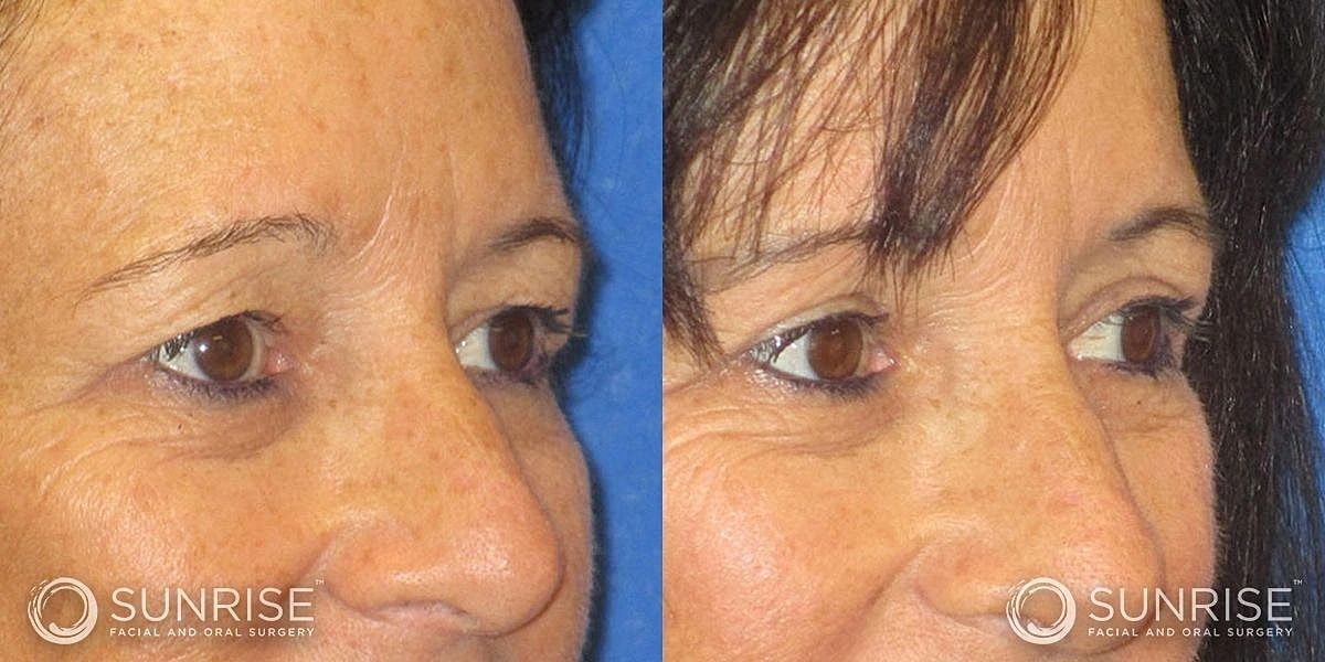 Blepharoplasty Before & After