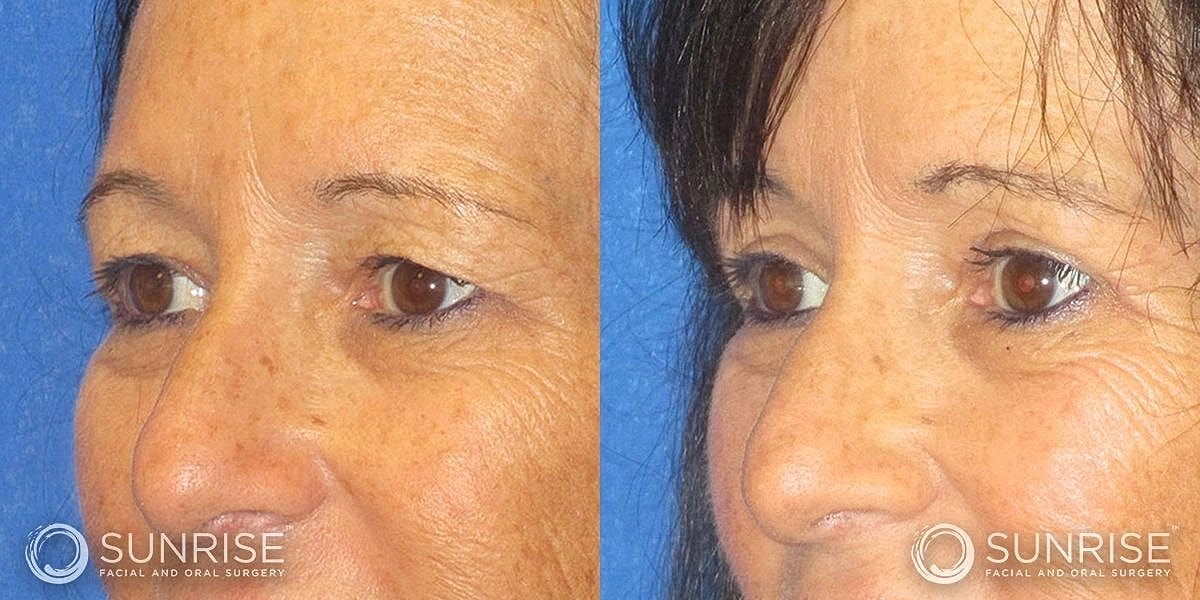 Blepharoplasty Before & After