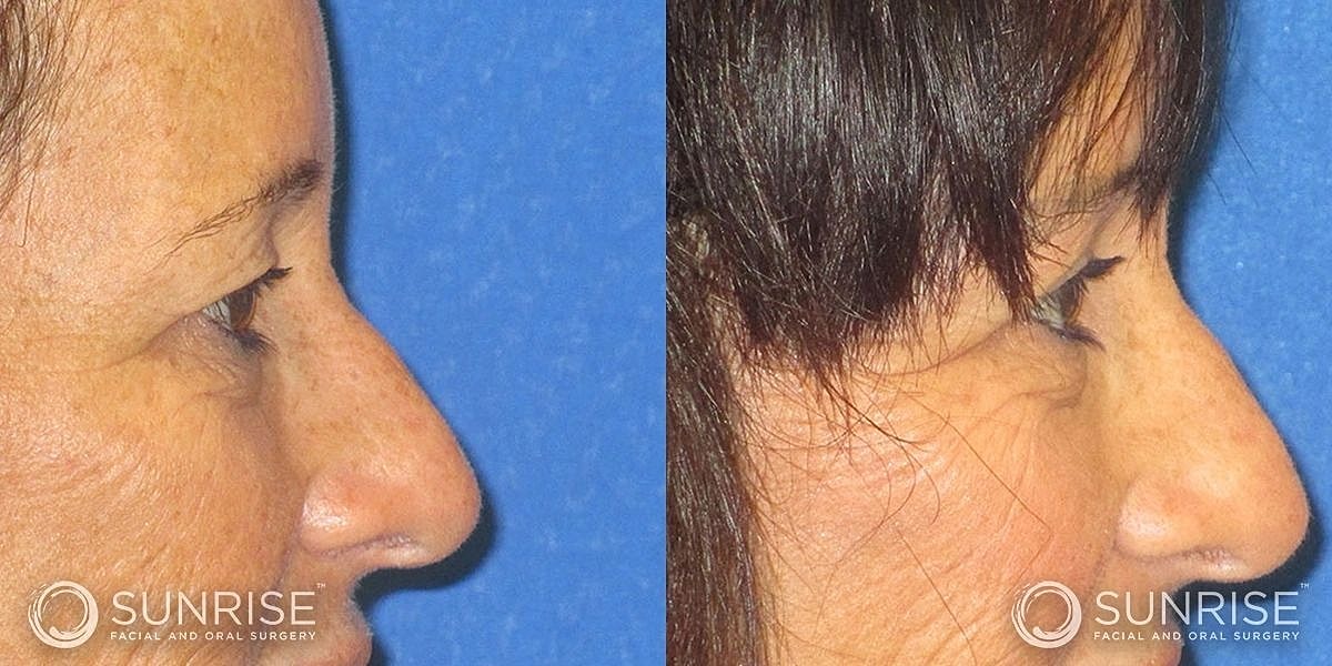 Blepharoplasty Before & After