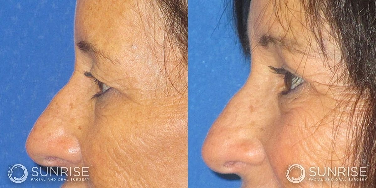Blepharoplasty Before & After