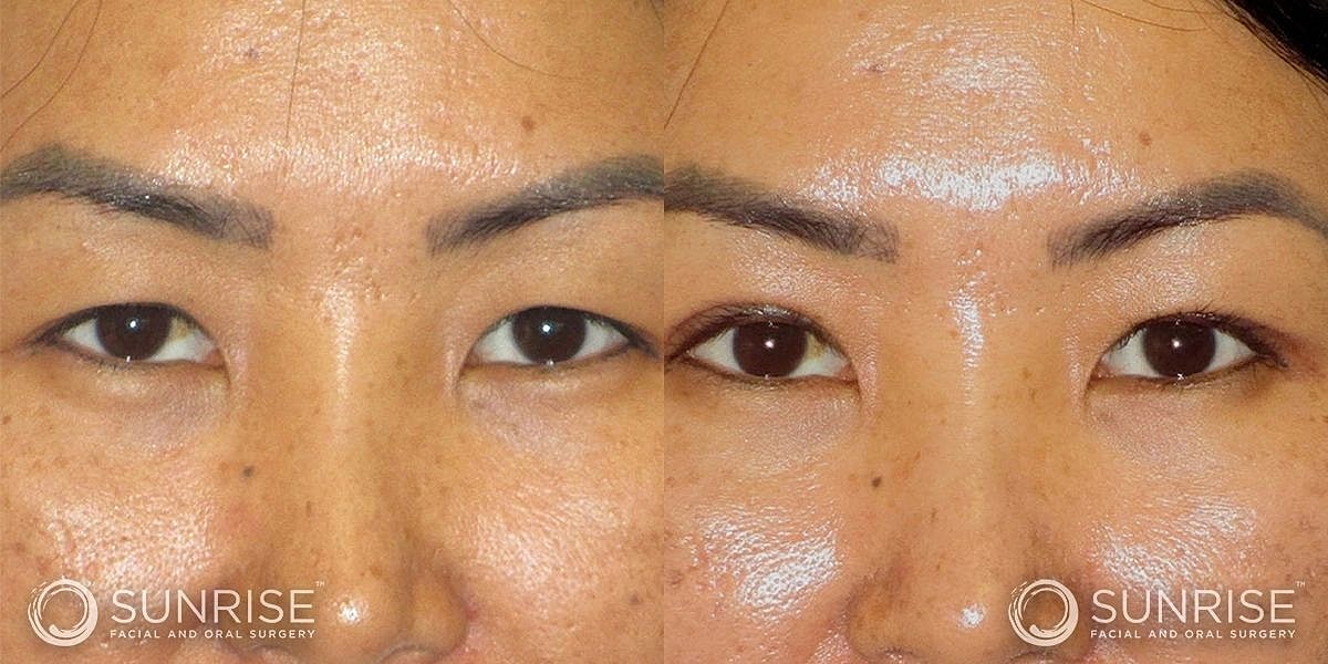 Blepharoplasty Before & After
