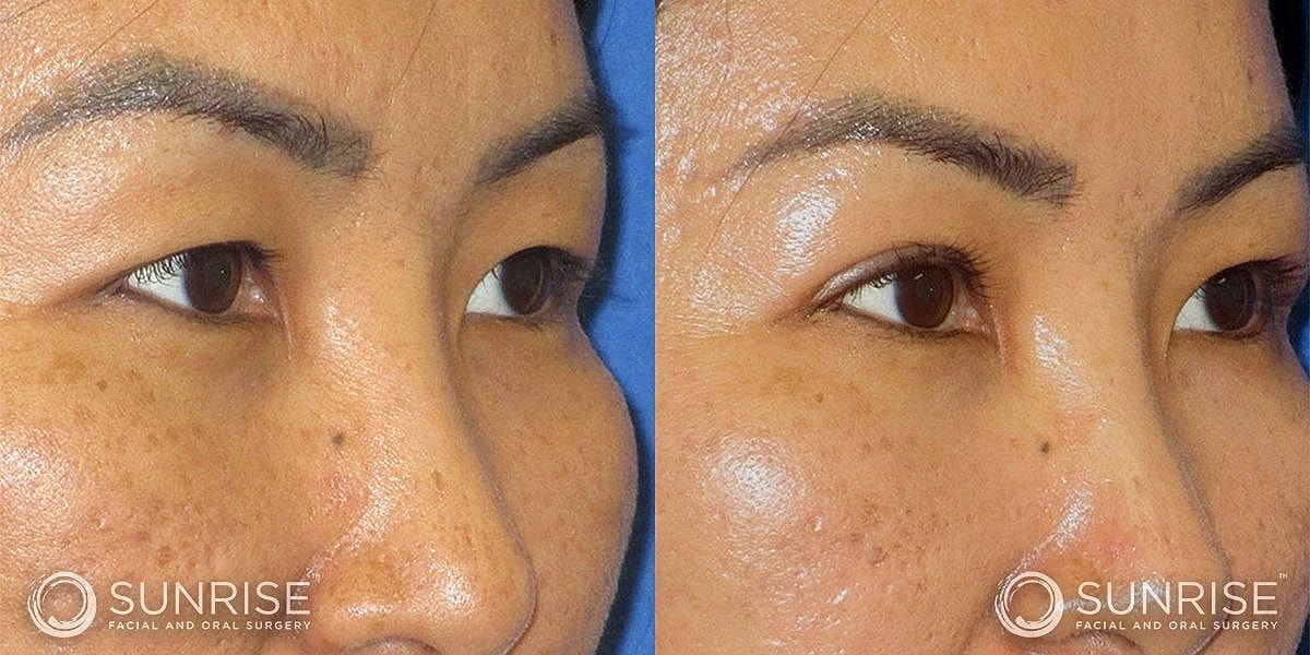 Blepharoplasty Before & After