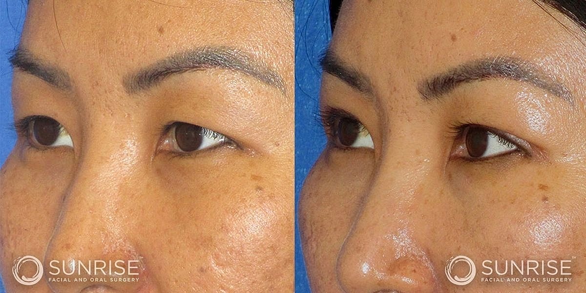 Blepharoplasty Before & After
