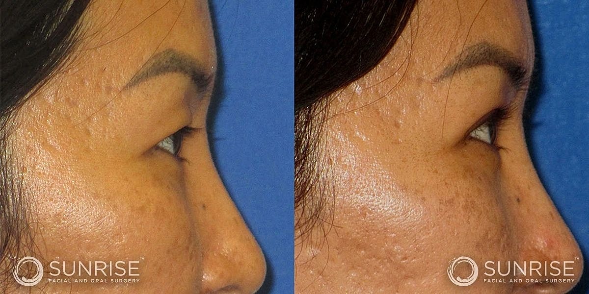 Blepharoplasty Before & After