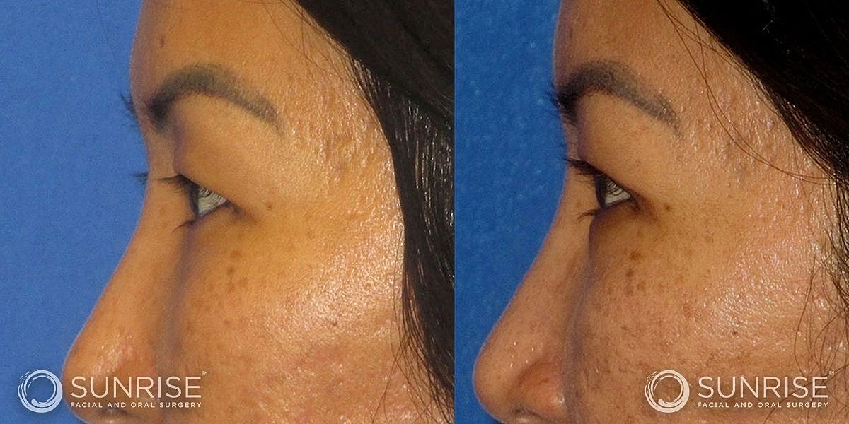 Blepharoplasty Before & After