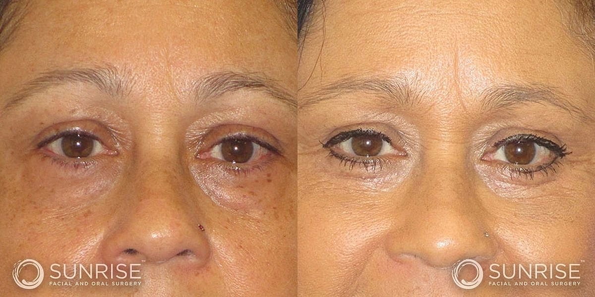 Blepharoplasty Before & After