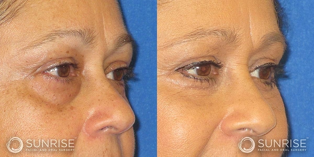 Blepharoplasty Before & After