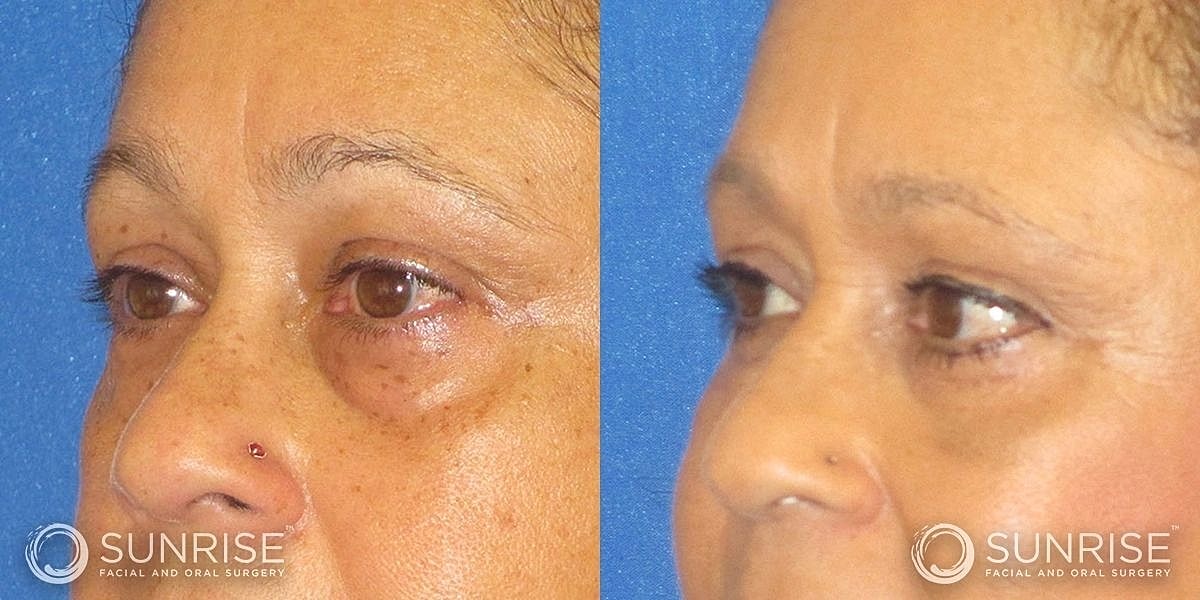 Blepharoplasty Before & After