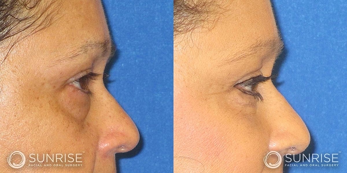 Blepharoplasty Before & After