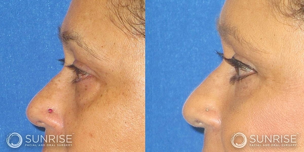 Blepharoplasty Before & After