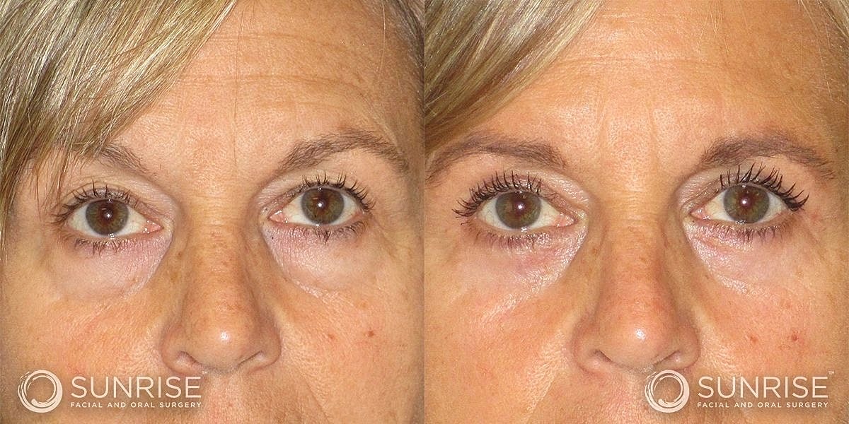 Blepharoplasty Before & After
