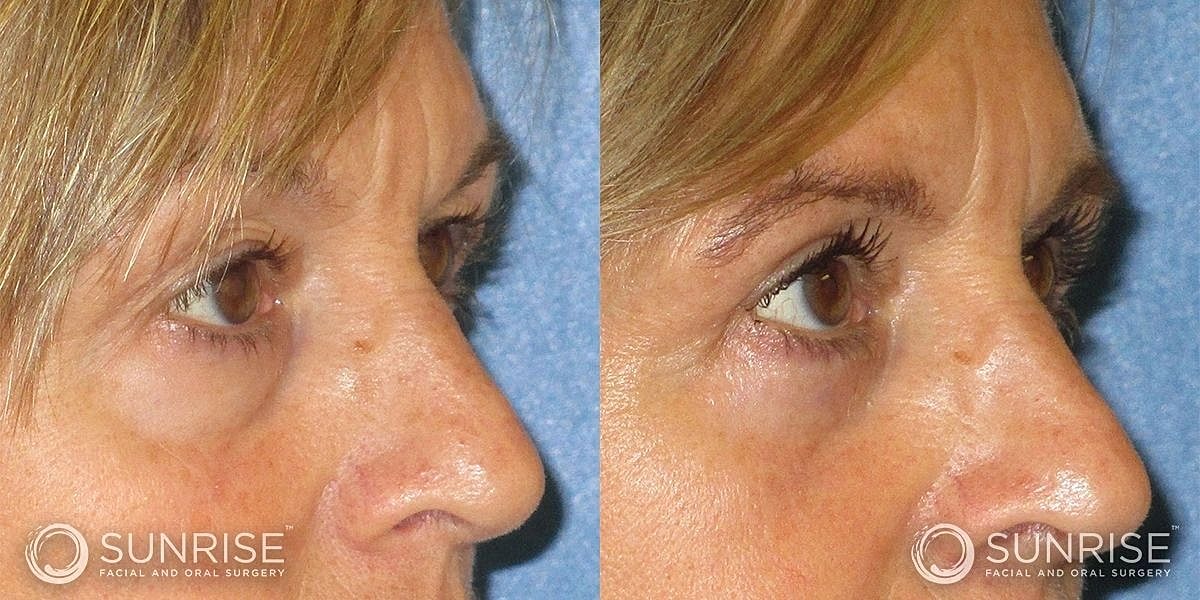 Blepharoplasty Before & After