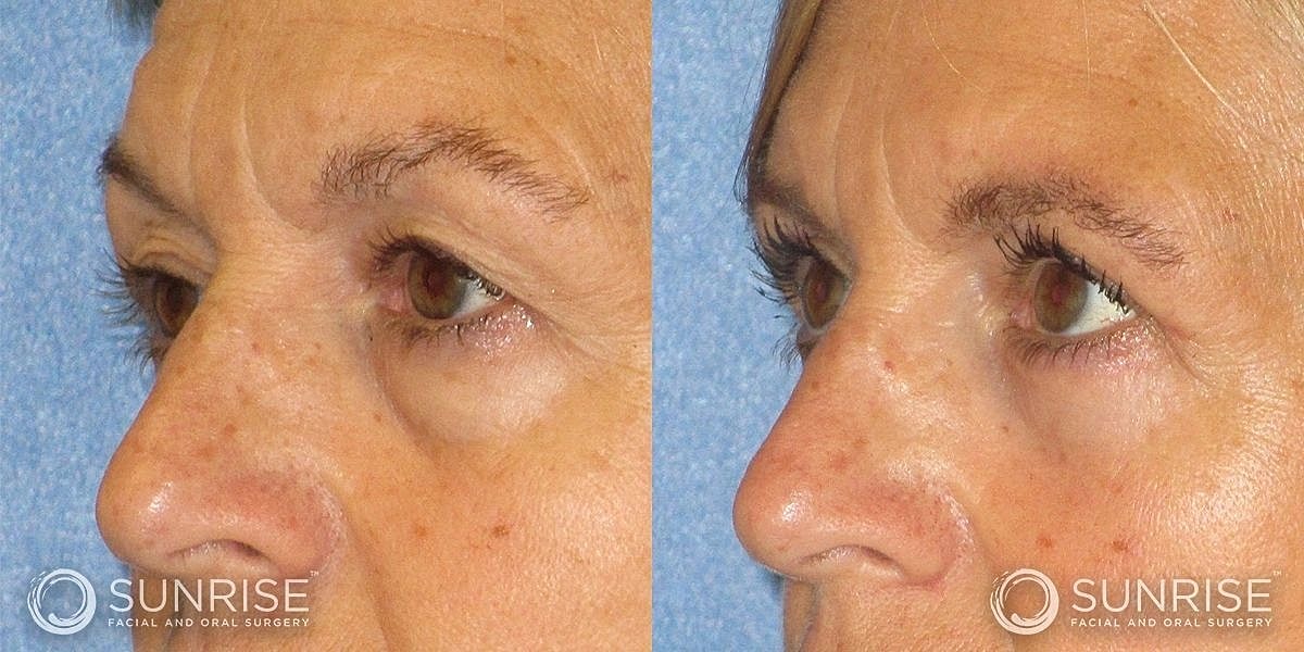 Blepharoplasty Before & After