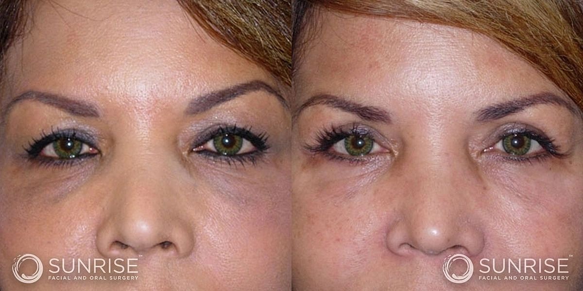 Blepharoplasty Before & After