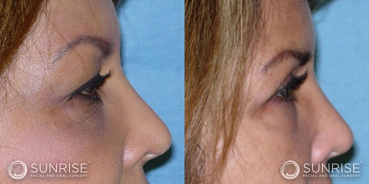 Blepharoplasty Before & After