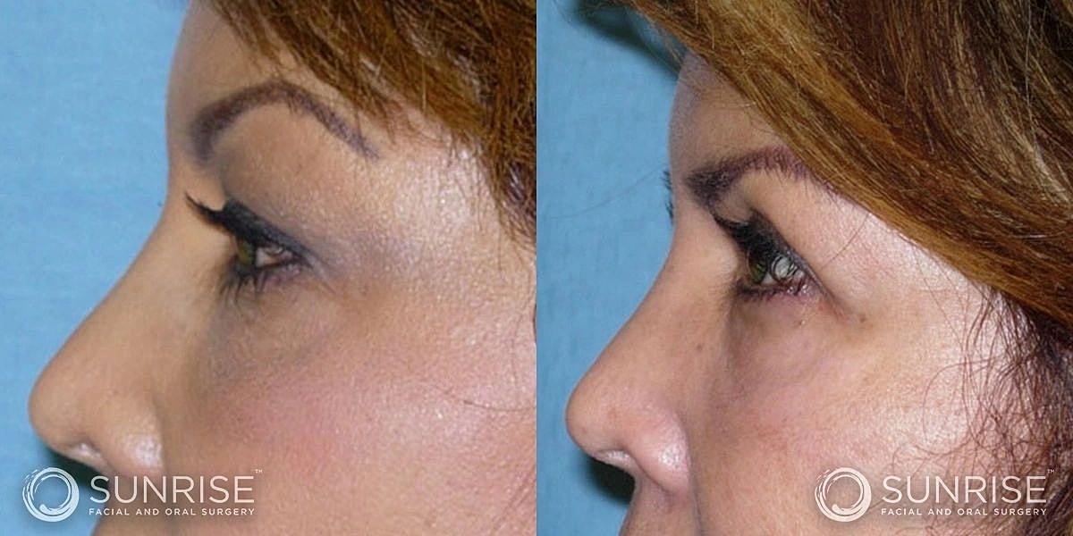 Blepharoplasty Before & After