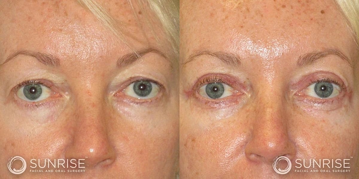 Blepharoplasty Before & After