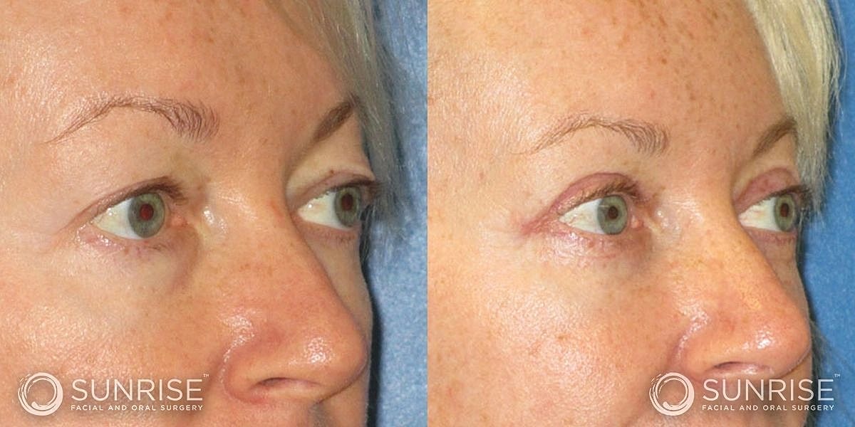 Blepharoplasty Before & After