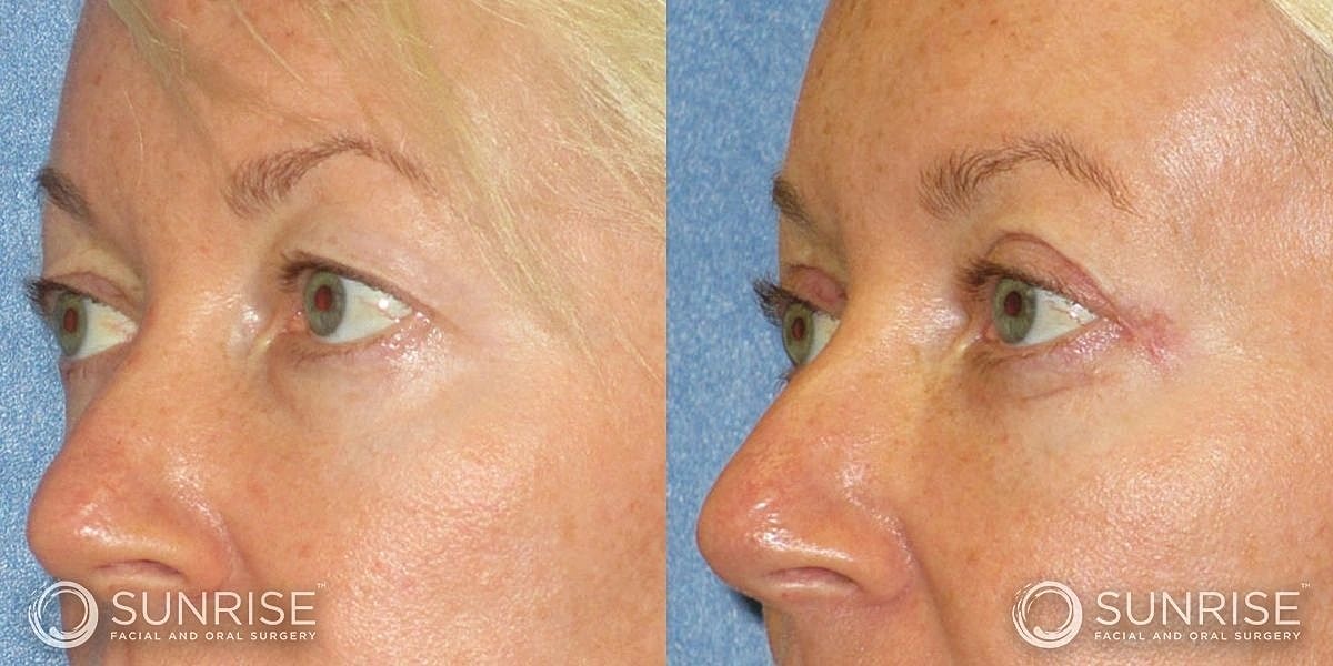 Blepharoplasty Before & After
