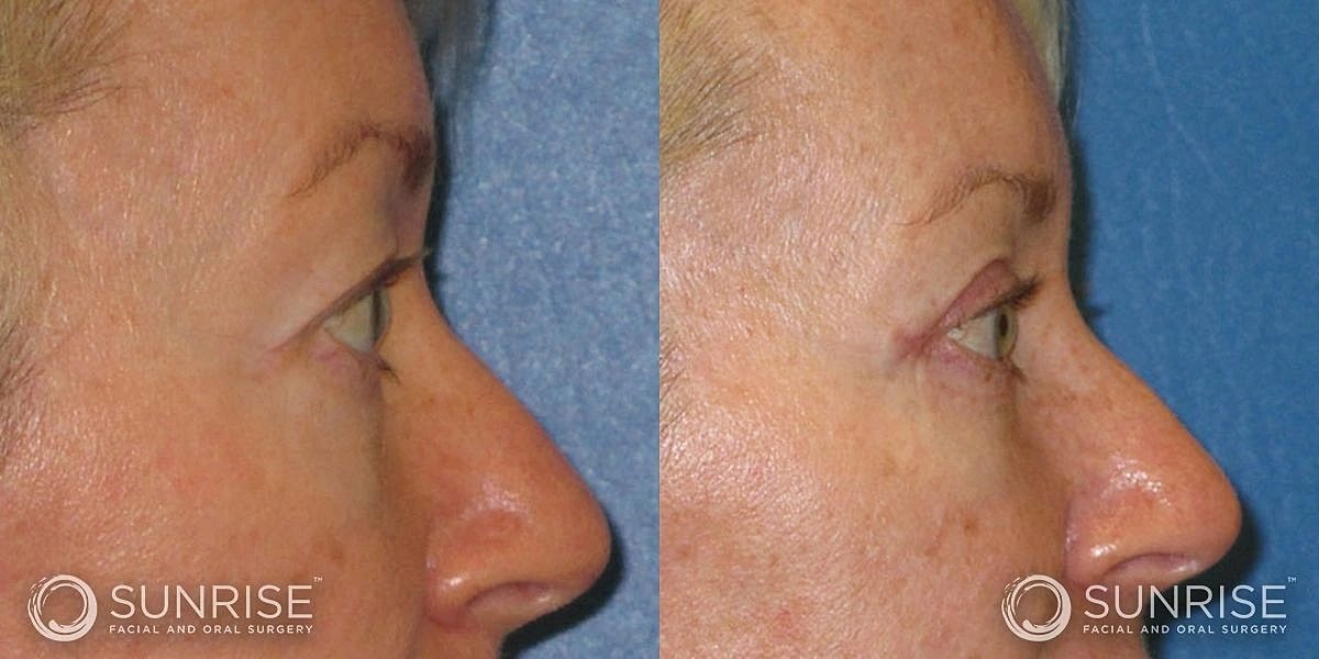 Blepharoplasty Before & After