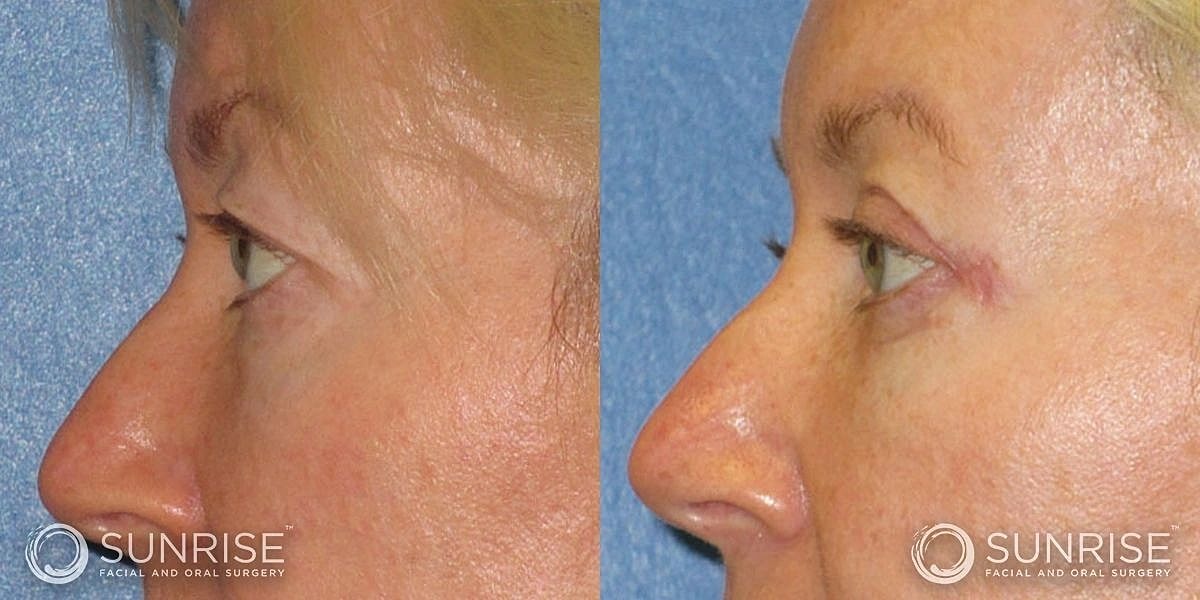 Blepharoplasty Before & After