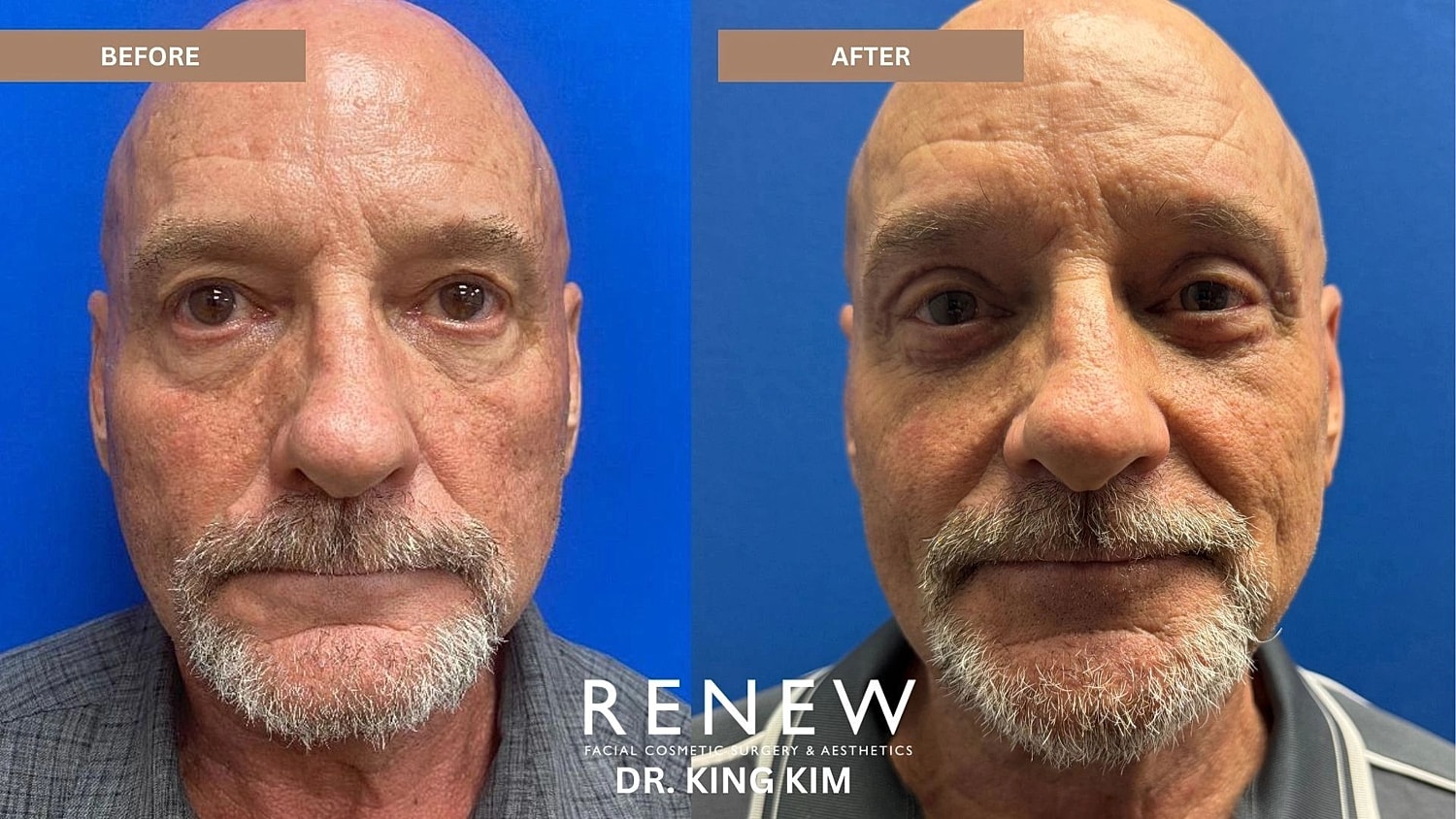 Blepharoplasty Before & After
