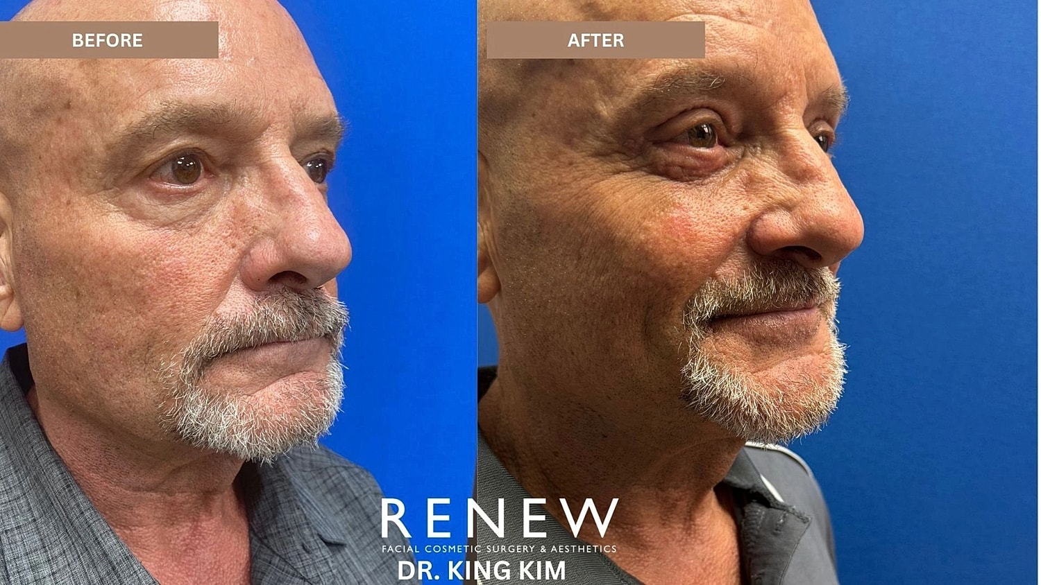 Blepharoplasty Before & After
