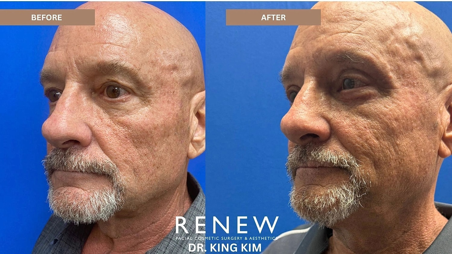 Blepharoplasty Before & After
